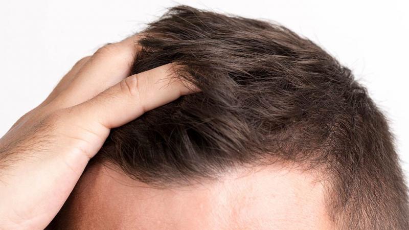 A Few Myths Related To FUE Hair Transplant