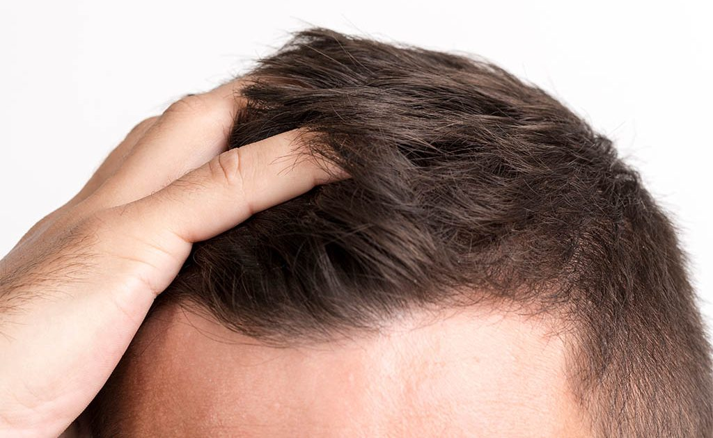 A Few Myths Related To FUE Hair Transplant