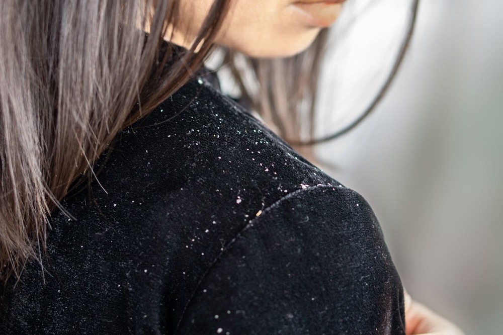 Facing Dandruff Problems? You Might Want To Change Your Shampoo!