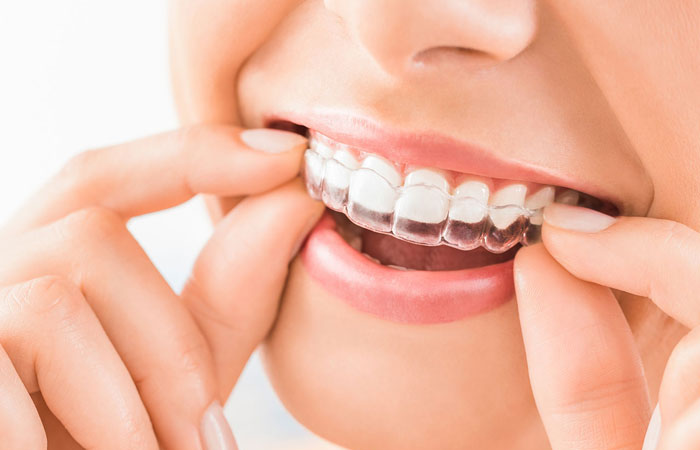 Clear Aligners and Their Benefits – An Overview on The Topic