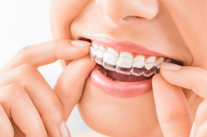 Clear Aligners and Their Benefits – An Overview on The Topic