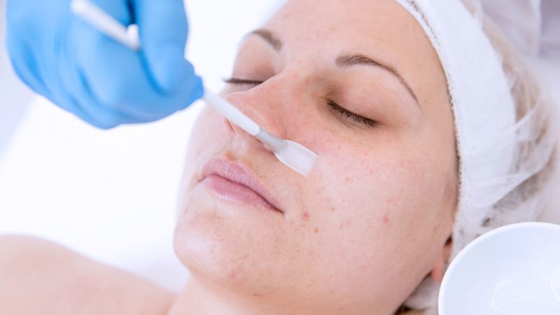 CHEMICAL PEELS FOR SENSITIVE AND FRAGILE SKIN