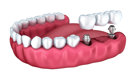 Here’s a detailed procedural guide for getting dental implants!