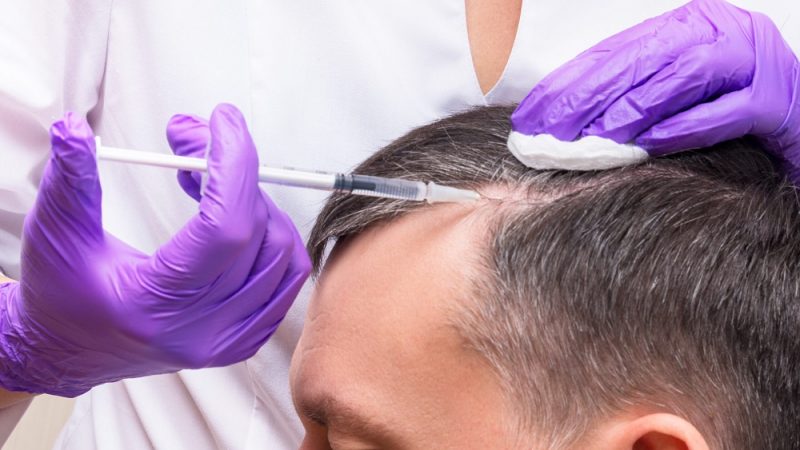 The Success Rate Of A Hair Transplant Treatment 