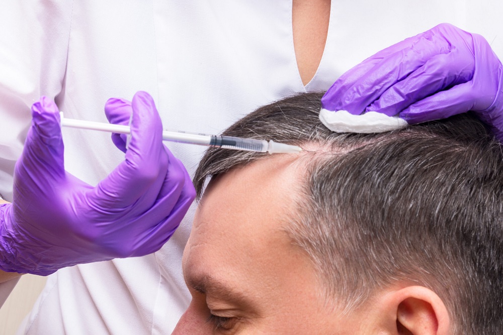 The Success Rate Of A Hair Transplant Treatment