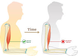 Duchenne muscular dystrophy and its causes?