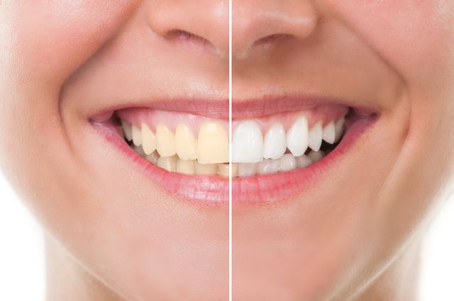Learn How White Should Your Teeth Be