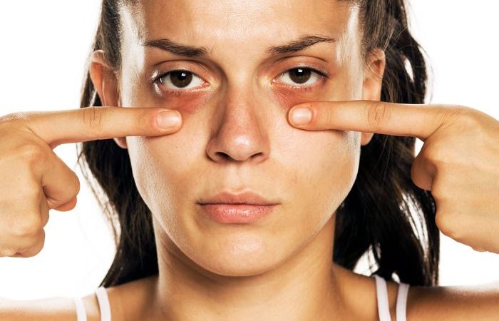 Effective Treatments For Eyebags Removal