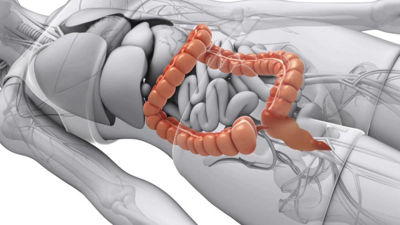How The Long Island Colon Surgeons Perform Colectomy?