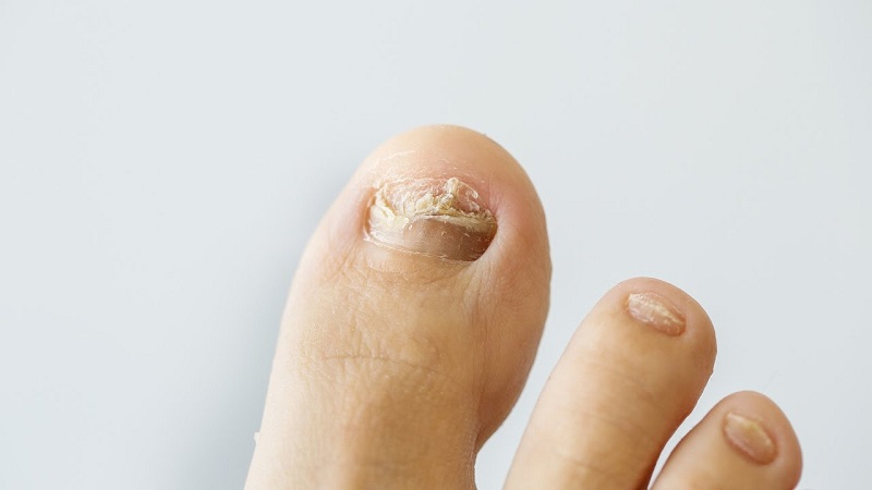 6 remedies to try for treating nail fungus