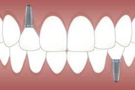 Dental Implant Surgery: What to Expect