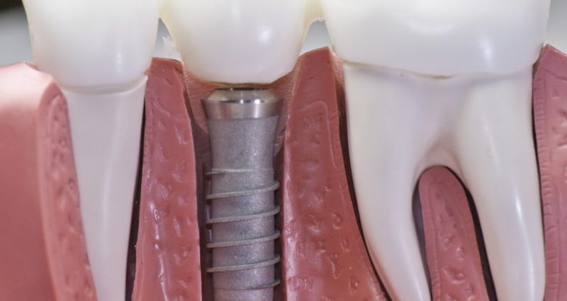 Your Dental Implant Recovery Guide