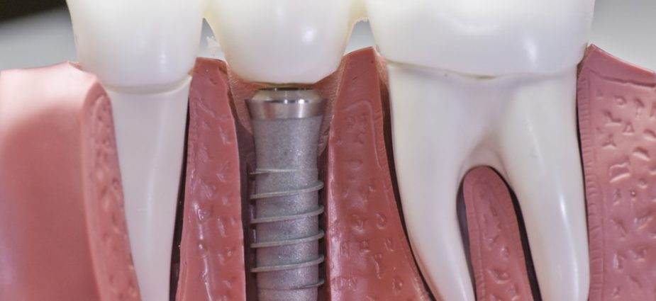 Your Dental Implant Recovery Guide