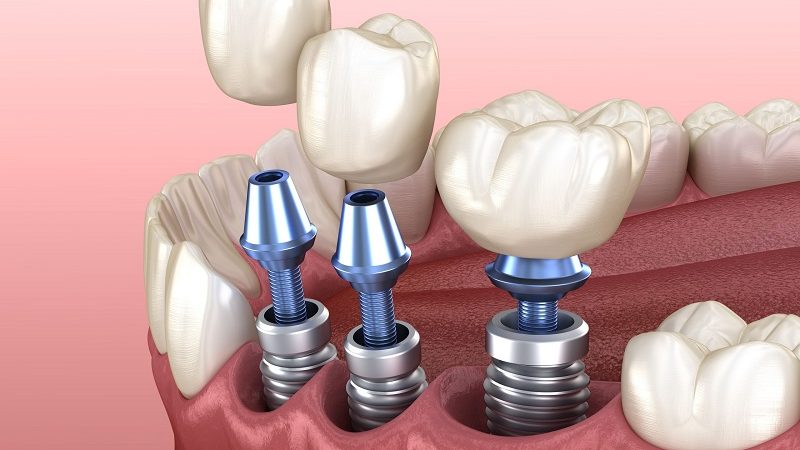 Dental Implants: Your Quick Guide
