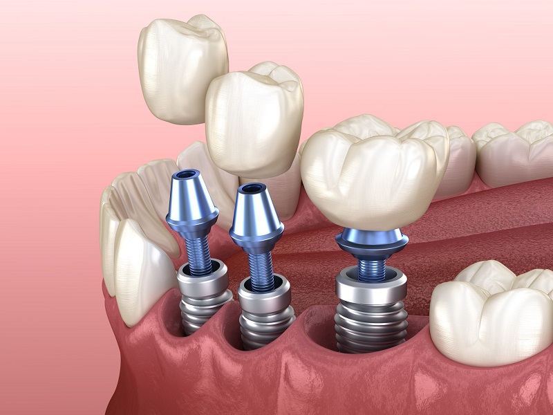 Dental Implants: Your Quick Guide