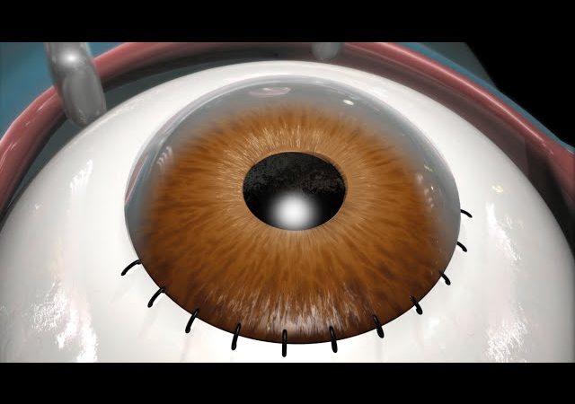 UNDERSTANDING MORE ABOUT CATARACT SURGERY
