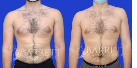 5 Life-Changing Advantages of Gynecomastia Surgery