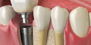 What to Know Before Getting Dental Implants