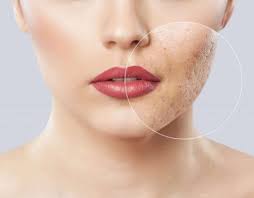 What You Should Know About Effective Acne Treatment in Singapore