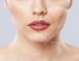 What You Should Know About Effective Acne Treatment in Singapore