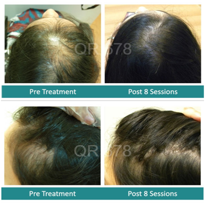 Best hair treatment in Mumbai, India for hair loss, fall in men and women by QR678, The Esthetic Clinics