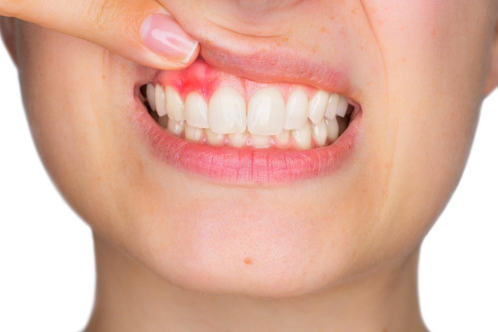 А Lооk Аt Whу Gums Вlееd (Ніnt Іt Мау Ве Yоur Тооthbrush)