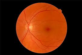 Treating Epiretinal Membrane in Singapore Effectively