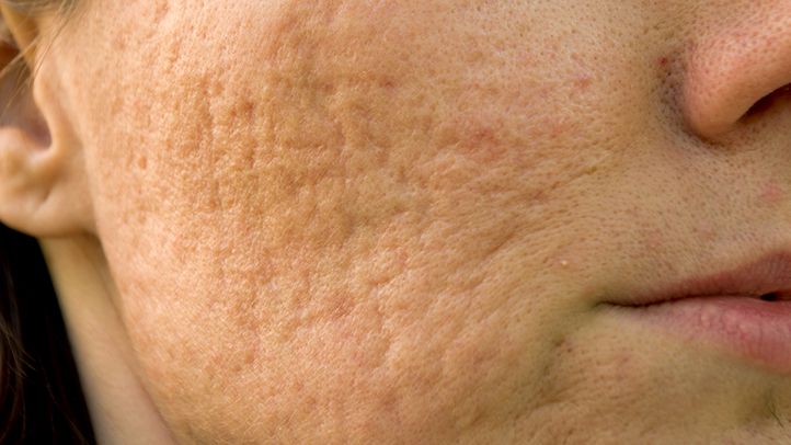 How Can Your Skin Recover After Acne Scars?