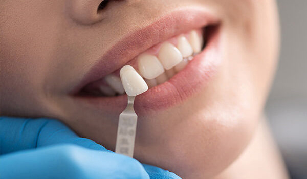 What Are the Major Differences Between Veneers And Crowns?