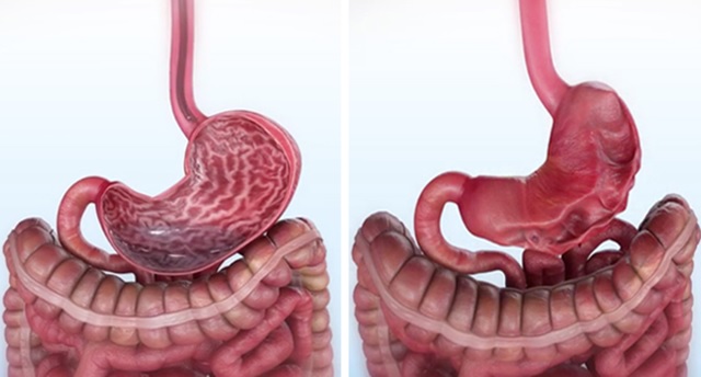 Everything You Need To Know About The endoscopic sleeve gastroplasty
