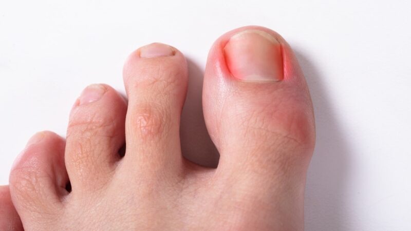 Ingrown Toenail Surgery: What to Expect