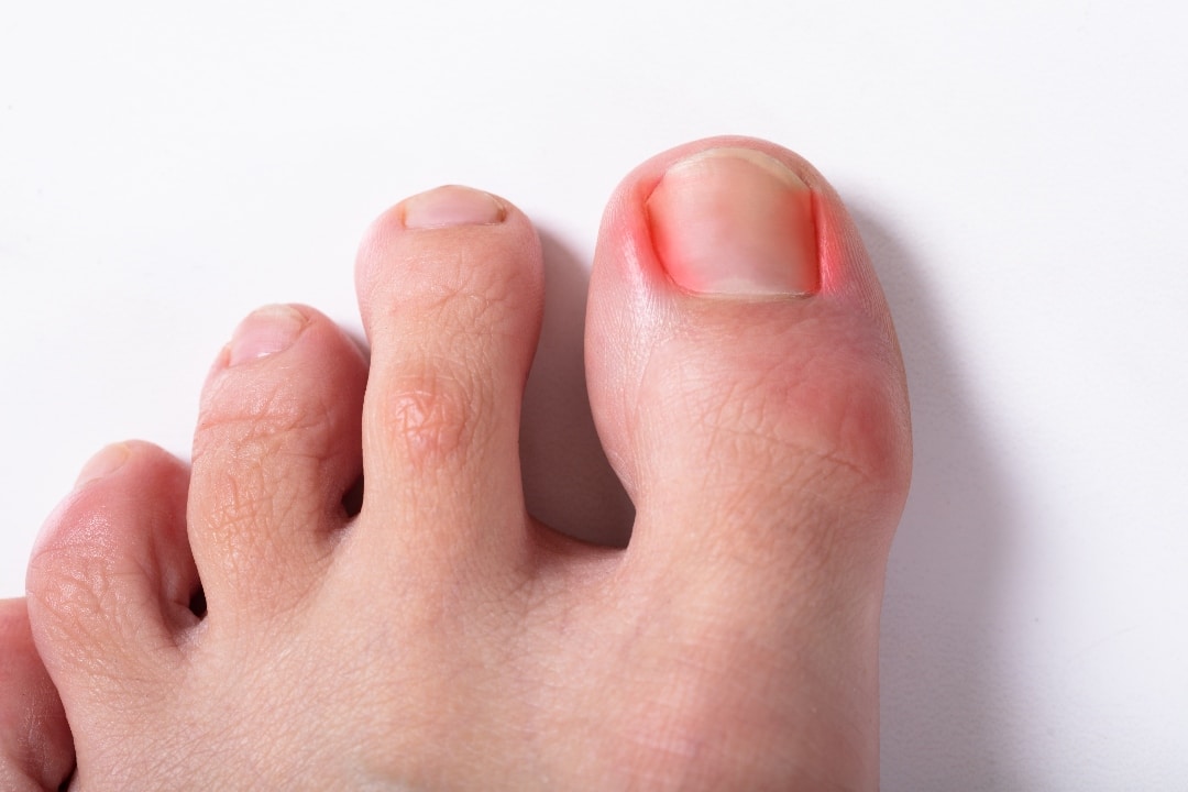 Ingrown Toenail Surgery: What to Expect