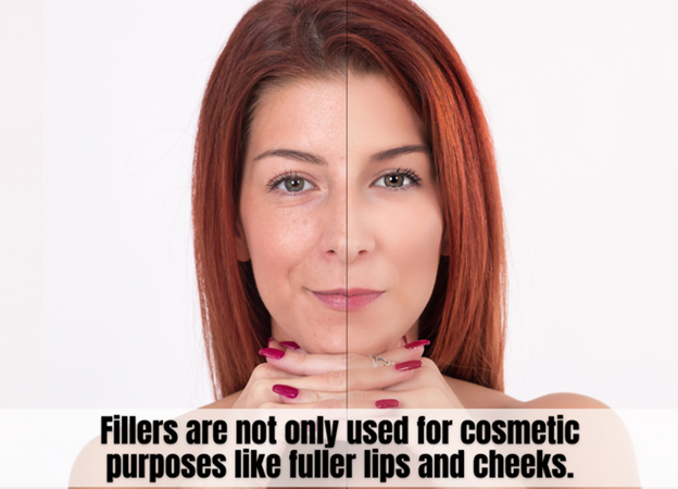    10 Benefits of Getting Dermal Fillers at Singapore Aesthetic Clinics