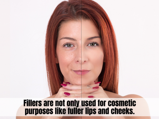    10 Benefits of Getting Dermal Fillers at Singapore Aesthetic Clinics