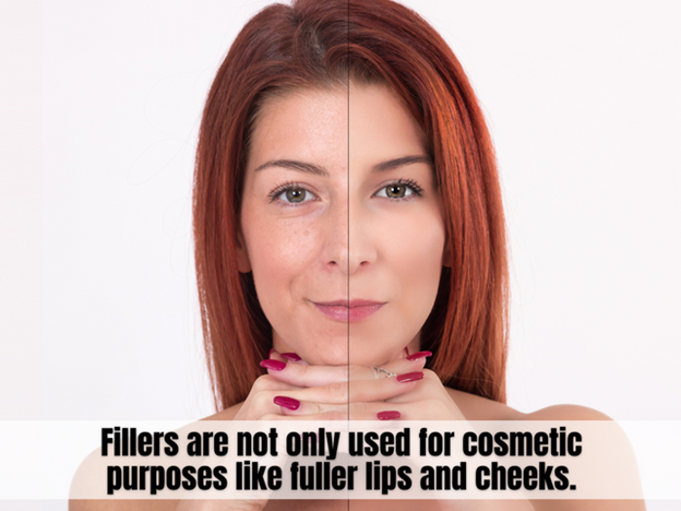 10 Benefits of Getting Dermal Fillers at Singapore Aesthetic Clinics