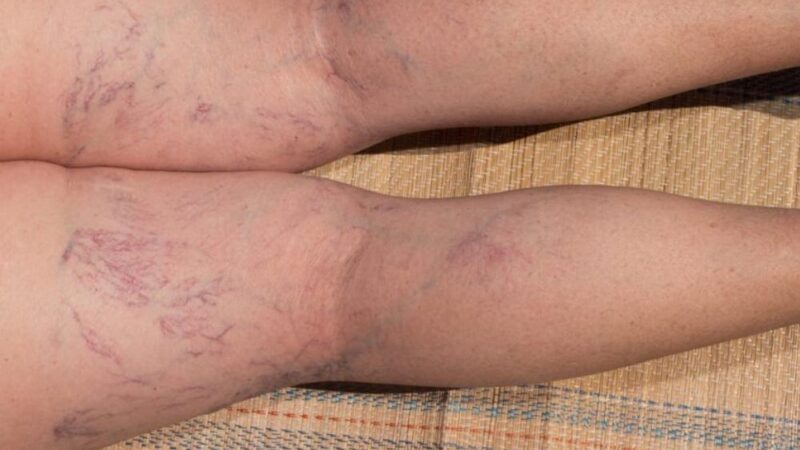 Facts About Spider Veins