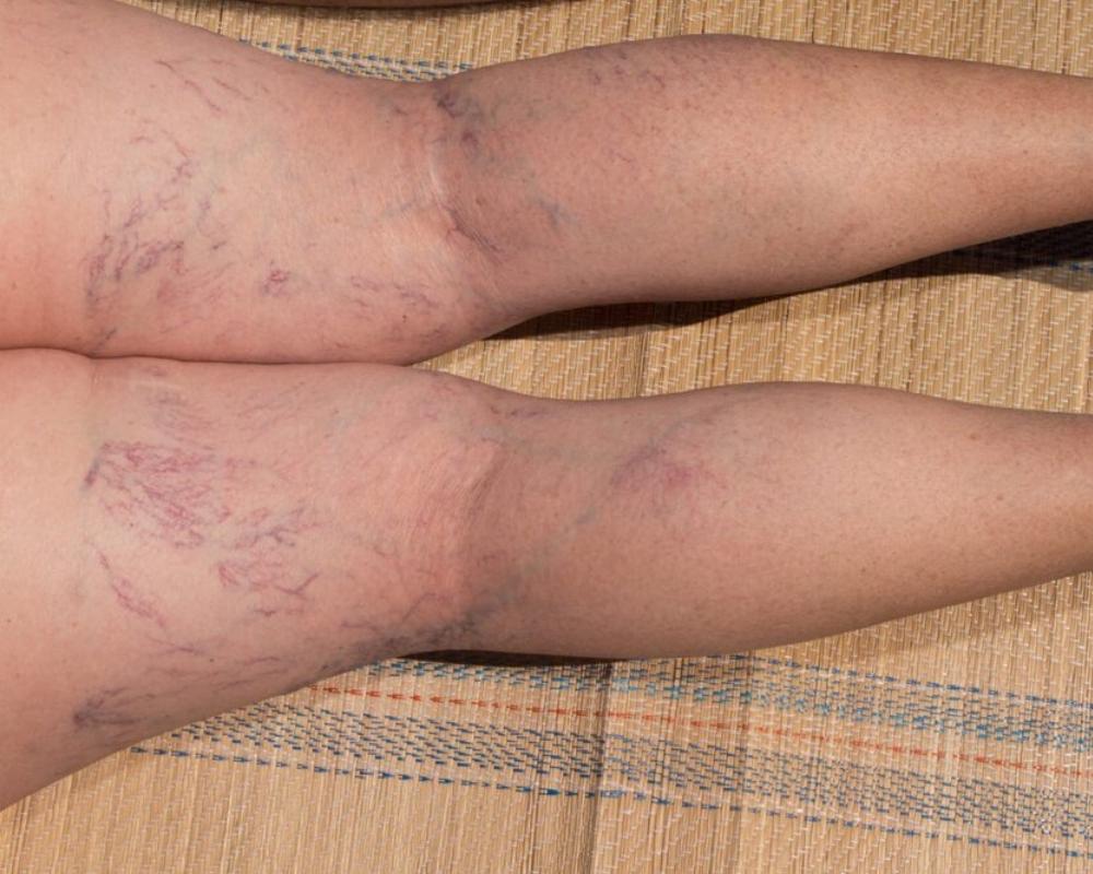 Facts About Spider Veins