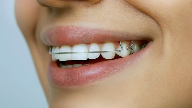 Teeth Retainers: Why Use Them and How To Keep Them Safe