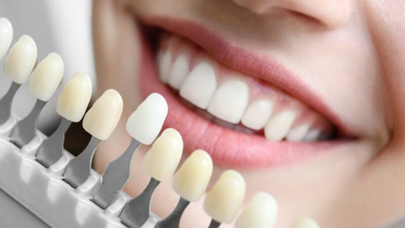 The Fastest Way To A Whiter Smile: Spa-Dent Professional Teeth Whitening System.