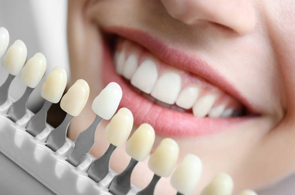 The Fastest Way To A Whiter Smile: Spa-Dent Professional Teeth Whitening System.