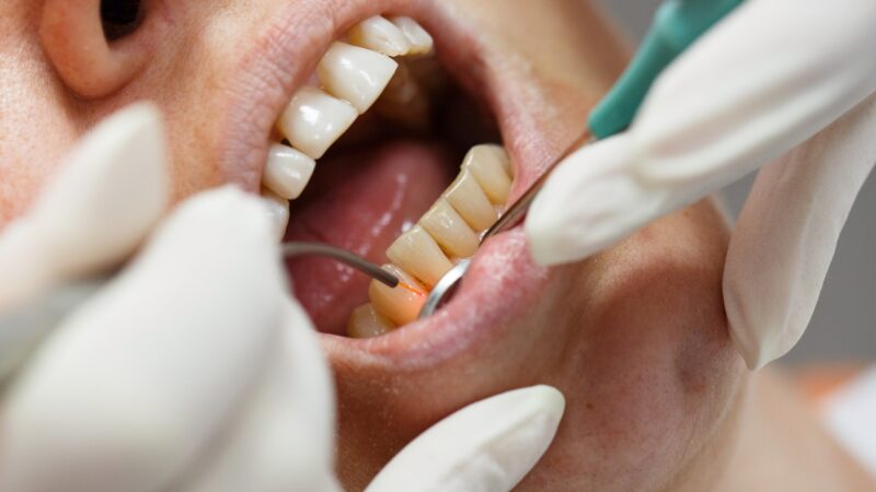 What You Should Know About Periodontal Surgery