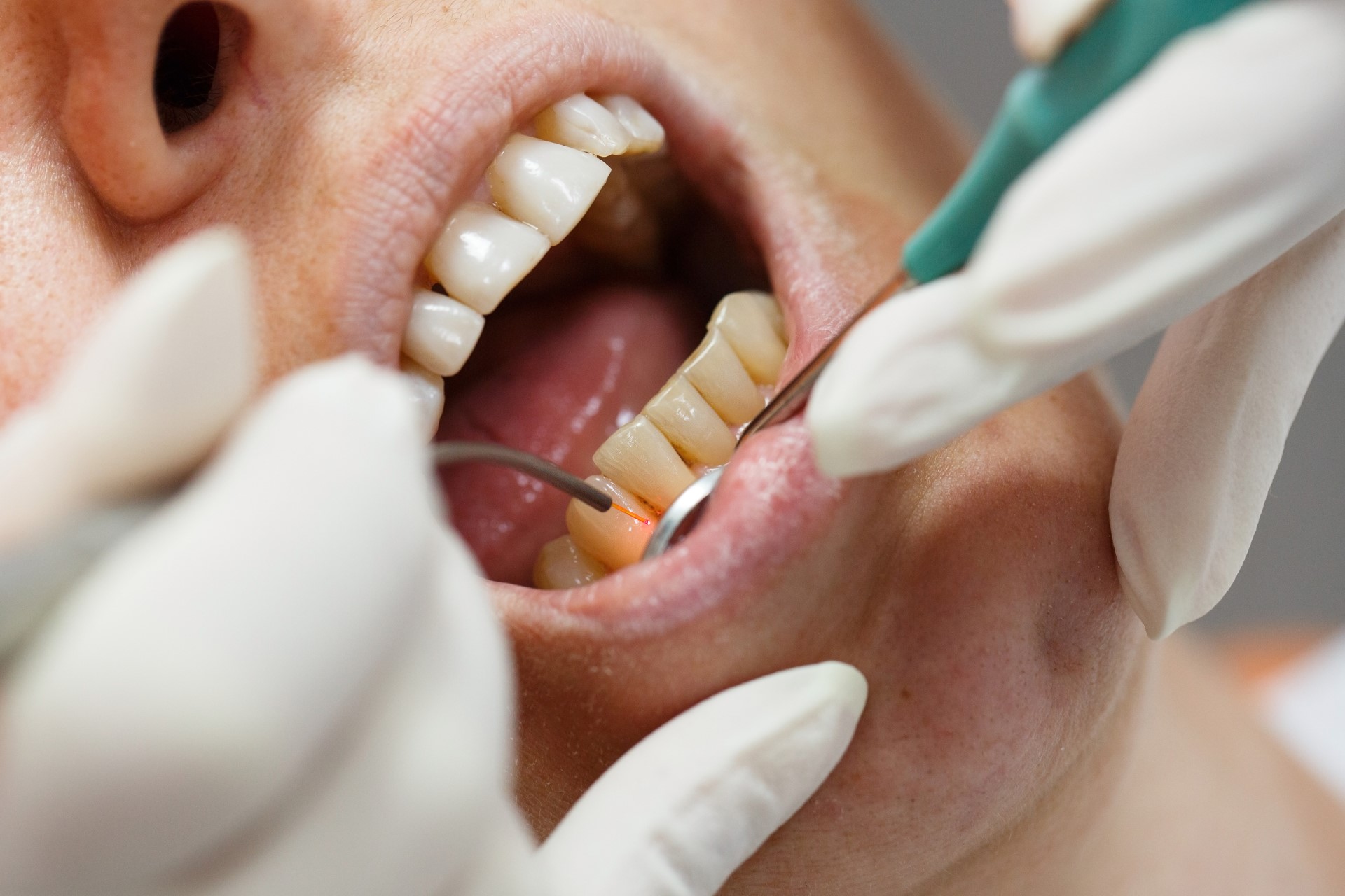 What You Should Know About Periodontal Surgery