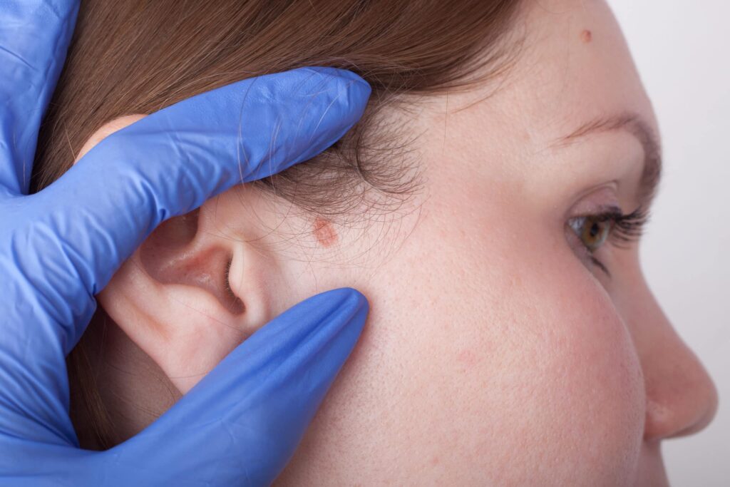 What You Need to Know About Mohs Surgery