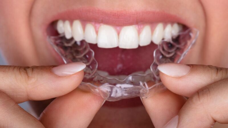 All You Need to Know About Retainers