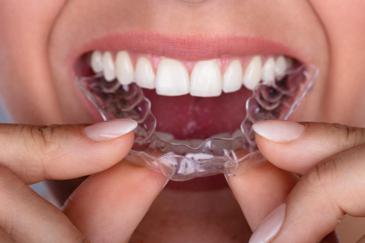 All You Need to Know About Retainers