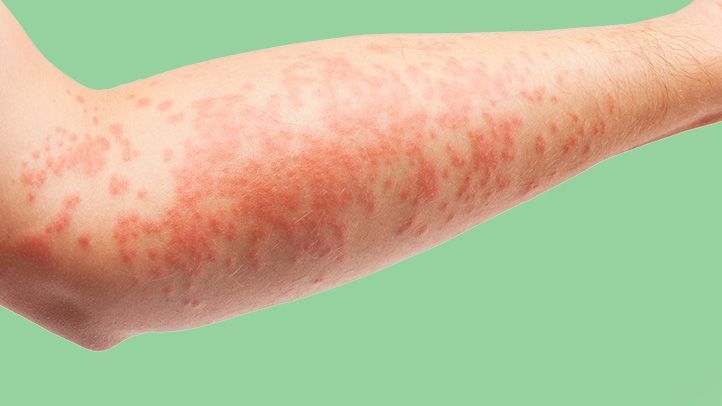 Types of Eczema