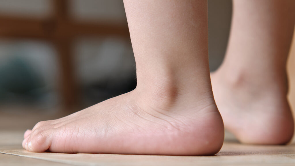Get Effective Flat Feet Treatment in The Woodlands, Texas