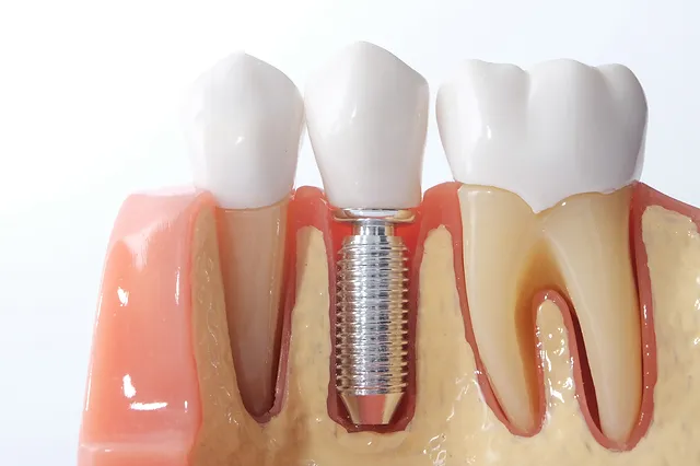 Facts Your Orthodontist Wants You to Know about Dental Implants