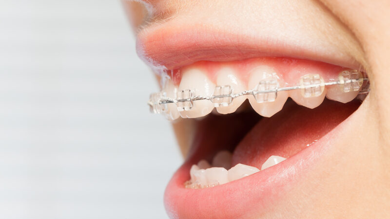 Why You Might Need Surgical Orthodontics