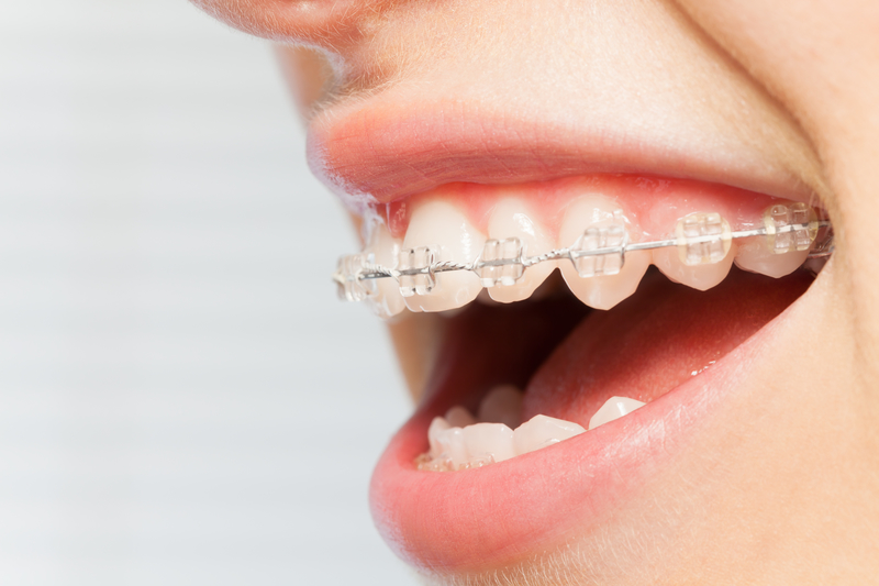 Why You Might Need Surgical Orthodontics
